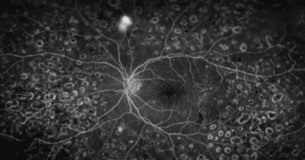 광각형광안저혈관조영에서 보이는 신생혈관 이미지