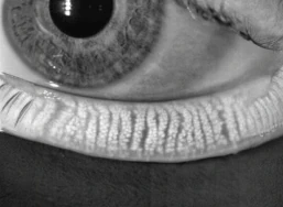 Keratograph 5M Imaging